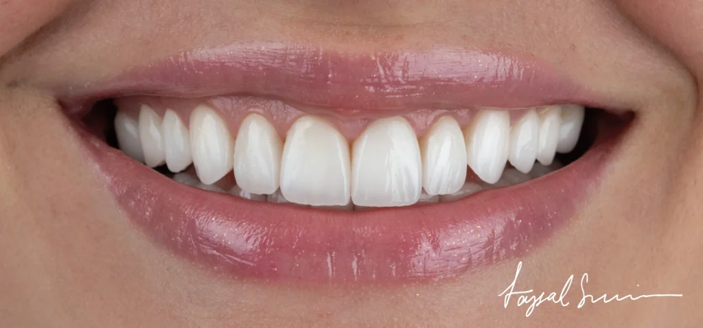 Veneers Vs. Crowns: Which Is Right For You?