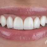 Veneers Vs. Crowns: Which Is Right For You?